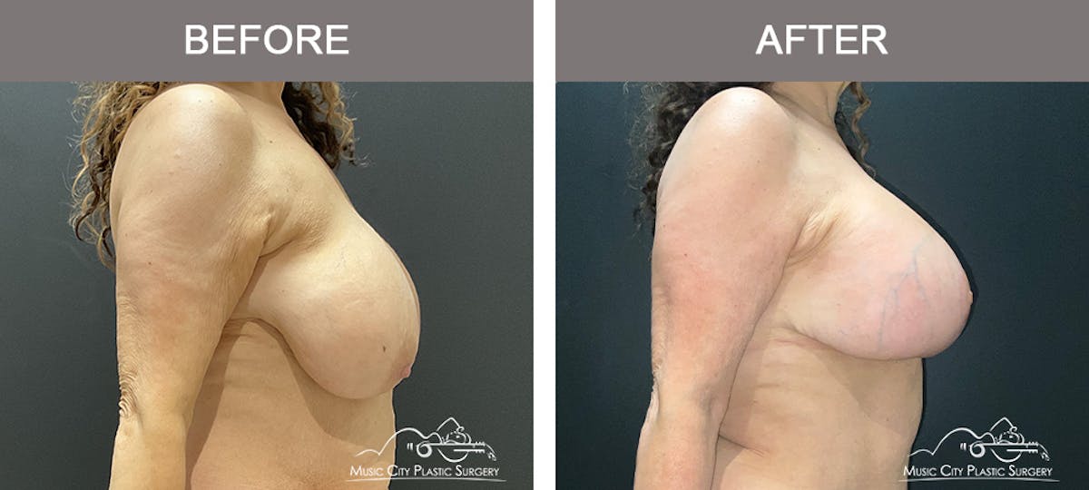 Breast Lift Before & After Gallery - Patient 154251 - Image 3