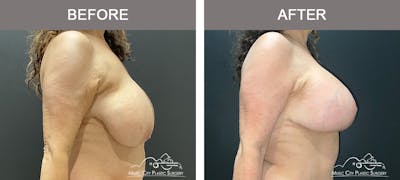 Breast Lift Before & After Gallery - Patient 154251 - Image 3
