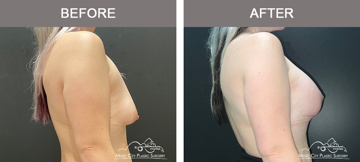 Breast Lift Before & After Gallery - Patient 148651 - Image 3