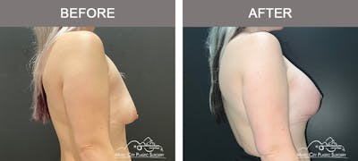 Breast Lift Before & After Gallery - Patient 148651 - Image 3