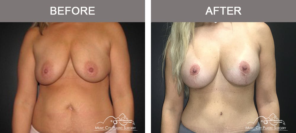 Mommy Makeover Before & After Gallery - Patient 90709210 - Image 1