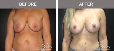 Mommy Makeover Before & After Gallery - Patient 90709210 - Image 1