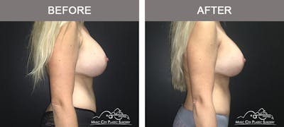 Mommy Makeover Before & After Gallery - Patient 90709210 - Image 3