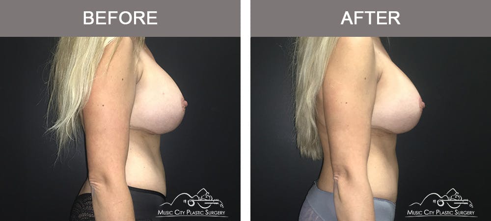 Mommy Makeover Before & After Gallery - Patient 90709210 - Image 3