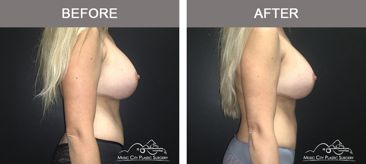 Mommy Makeover Before & After Gallery - Patient 90709210 - Image 3
