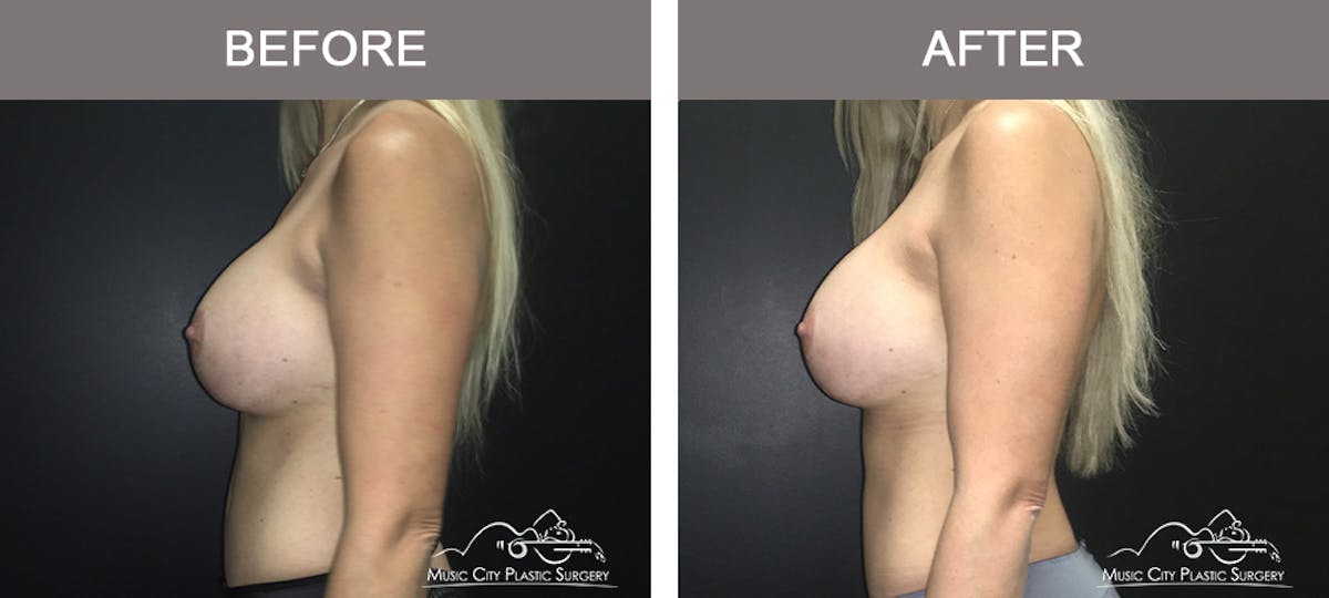 Mommy Makeover Before & After Gallery - Patient 90709210 - Image 4
