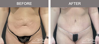 Breast Lift Before & After Gallery - Patient 224951 - Image 1