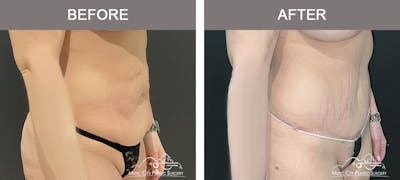 Liposuction Before & After Gallery - Patient 283317 - Image 2