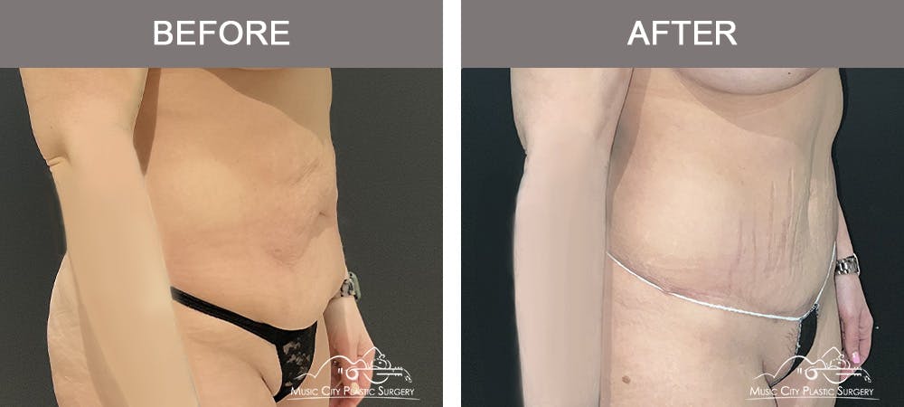 Breast Augmentation Before & After Gallery - Patient 427960 - Image 2