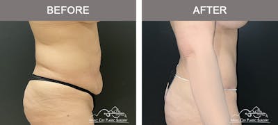 Liposuction Before & After Gallery - Patient 283317 - Image 3