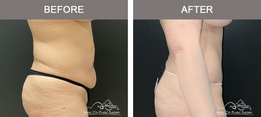 Breast Augmentation Before & After Gallery - Patient 427960 - Image 3