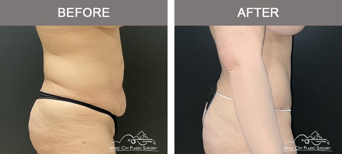 Breast Augmentation Before & After Gallery - Patient 427960 - Image 3