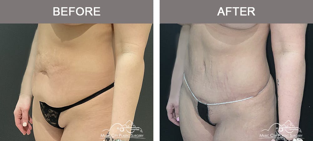 Breast Augmentation Before & After Gallery - Patient 427960 - Image 4