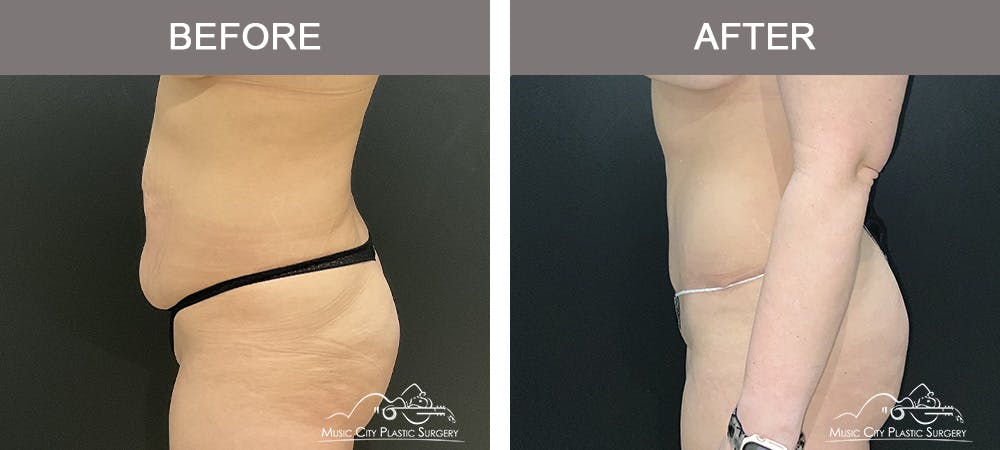 Breast Augmentation Before & After Gallery - Patient 427960 - Image 5