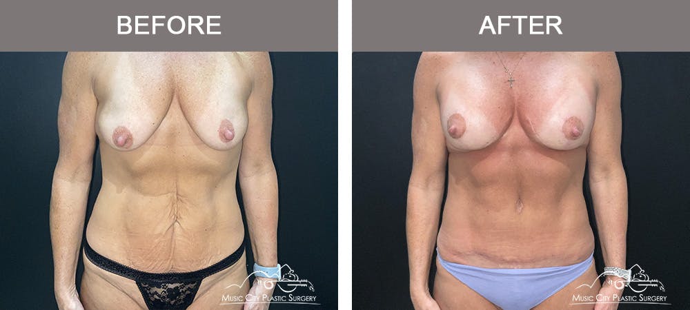 Breast Augmentation Before & After Gallery - Patient 388800 - Image 1