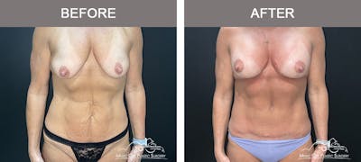 Breast Lift Before & After Gallery - Patient 399074 - Image 1