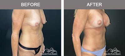 Mommy Makeover Before & After Gallery - Patient 193908 - Image 2