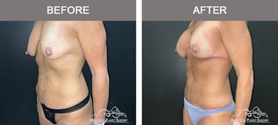 Mommy Makeover Before & After Gallery - Patient 193908 - Image 3
