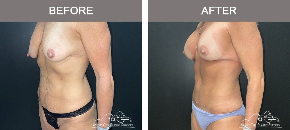 Breast Augmentation Before & After Gallery - Patient 388800 - Image 3