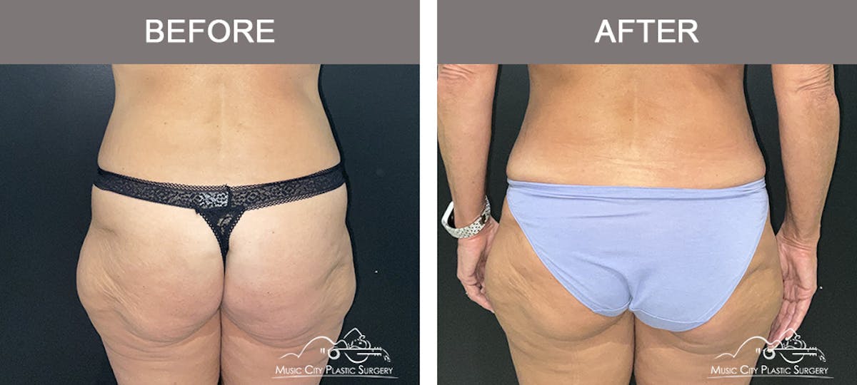 Tummy Tuck (Abdominoplasty) Before & After Gallery - Patient 411260 - Image 4