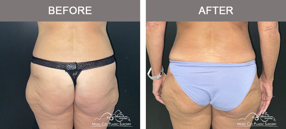 Breast Augmentation Before & After Gallery - Patient 388800 - Image 4