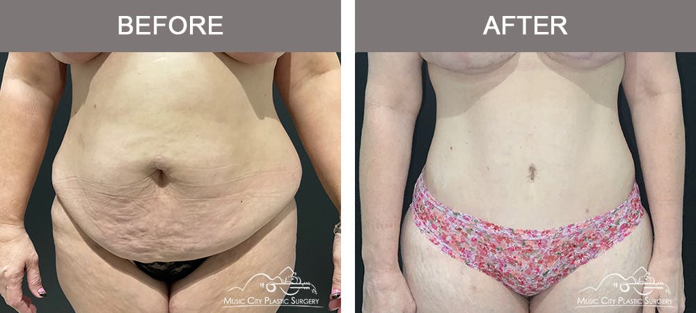 Mommy Makeover Before & After Gallery - Patient 195592415 - Image 1