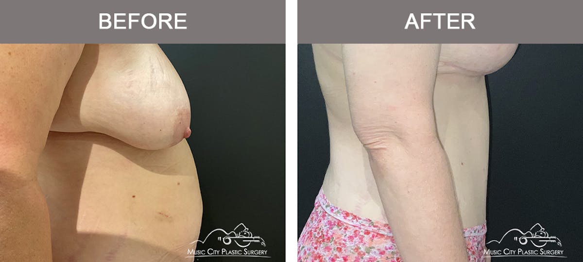 Mommy Makeover Before & After Gallery - Patient 195592415 - Image 2