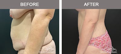 Mommy Makeover Before & After Gallery - Patient 195592415 - Image 3