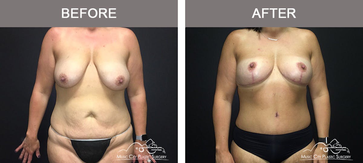 Mommy Makeover Before & After Gallery - Patient 90709178 - Image 1