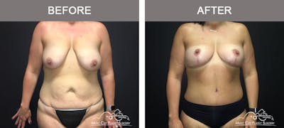 Mommy Makeover Before & After Gallery - Patient 90709178 - Image 1