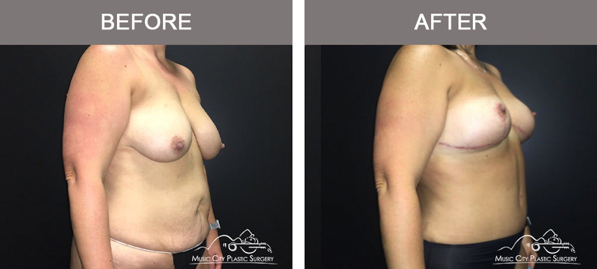 Mommy Makeover Before & After Gallery - Patient 90709178 - Image 2