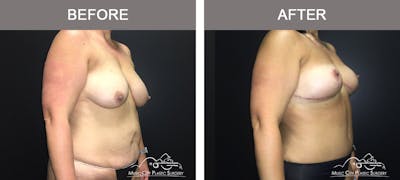 Mommy Makeover Before & After Gallery - Patient 90709178 - Image 2