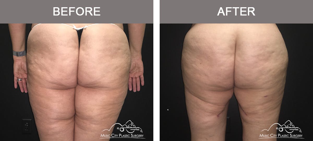 Mommy Makeover Before & After Gallery - Patient 90709178 - Image 6