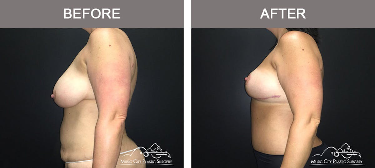 Mommy Makeover Before & After Gallery - Patient 90709178 - Image 3