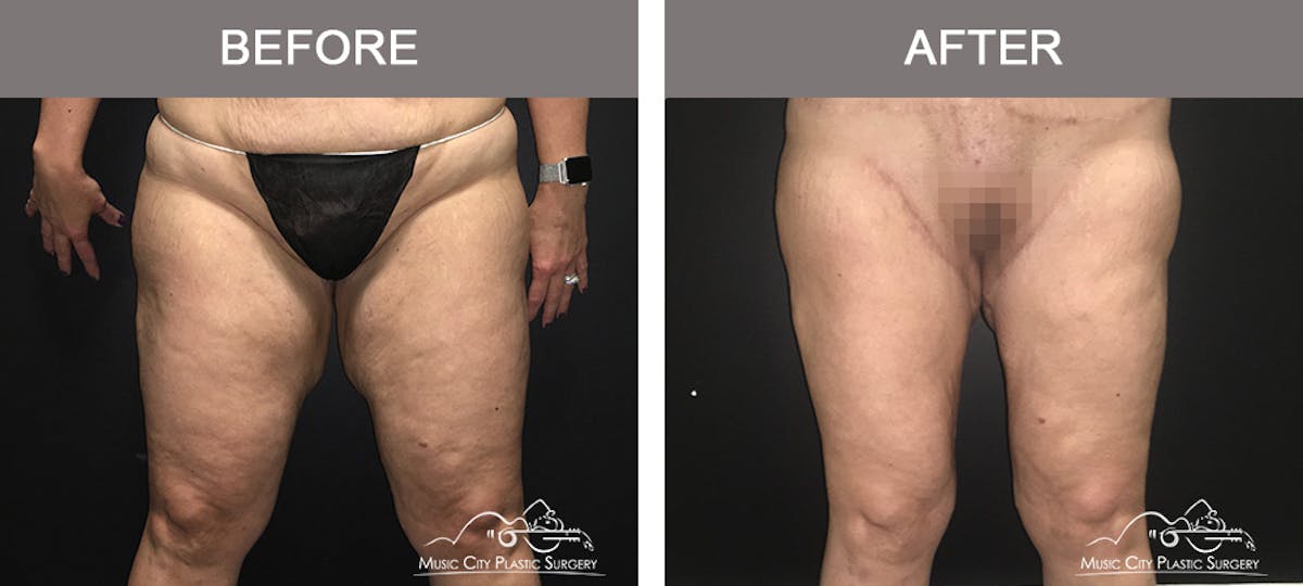 Mommy Makeover Before & After Gallery - Patient 90709178 - Image 7