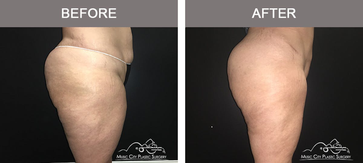 Mommy Makeover Before & After Gallery - Patient 90709178 - Image 5