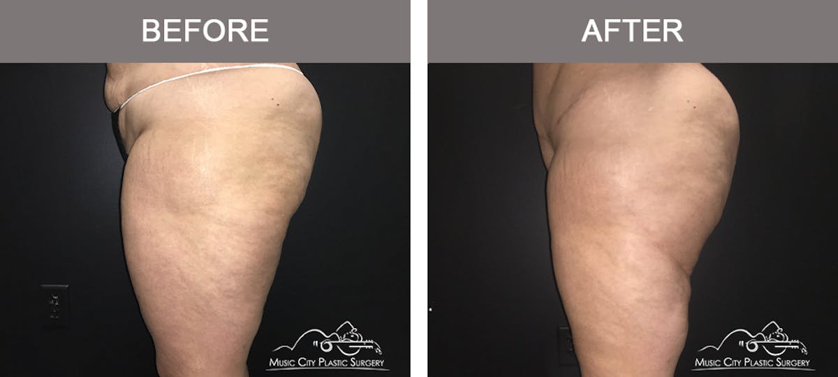 Mommy Makeover Before & After Gallery - Patient 90709178 - Image 4