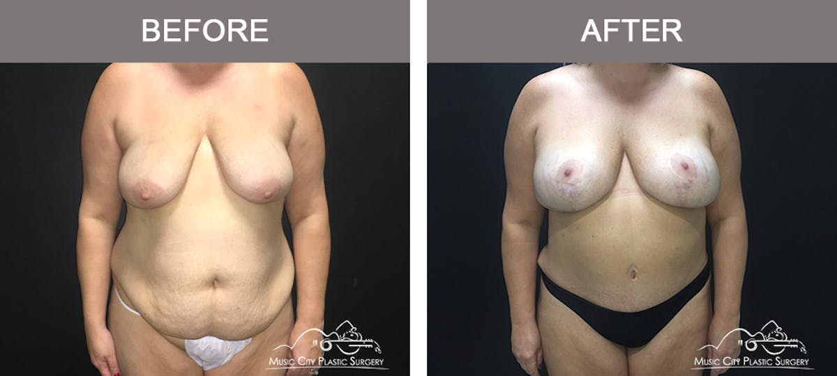 Breast Lift Before & After Gallery - Patient 339401 - Image 1