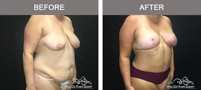 Mommy Makeover Before & After Gallery - Patient 90709156 - Image 2