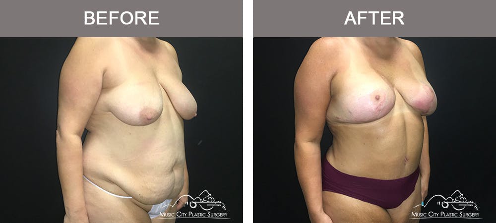 Breast Lift Before & After Gallery - Patient 339401 - Image 2