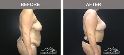 Mommy Makeover Before & After Gallery - Patient 90709156 - Image 3