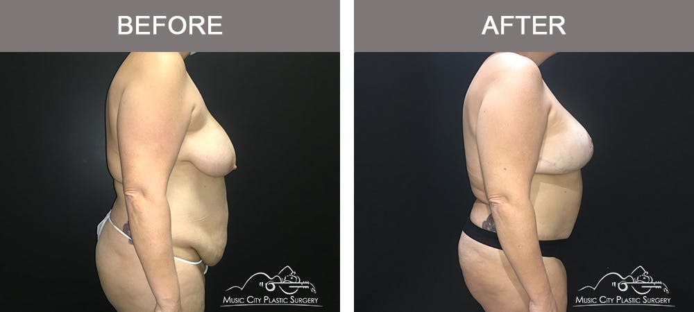 Breast Lift Before & After Gallery - Patient 339401 - Image 3