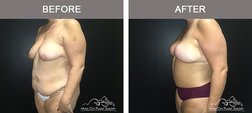 Breast Lift Before & After Gallery - Patient 339401 - Image 4