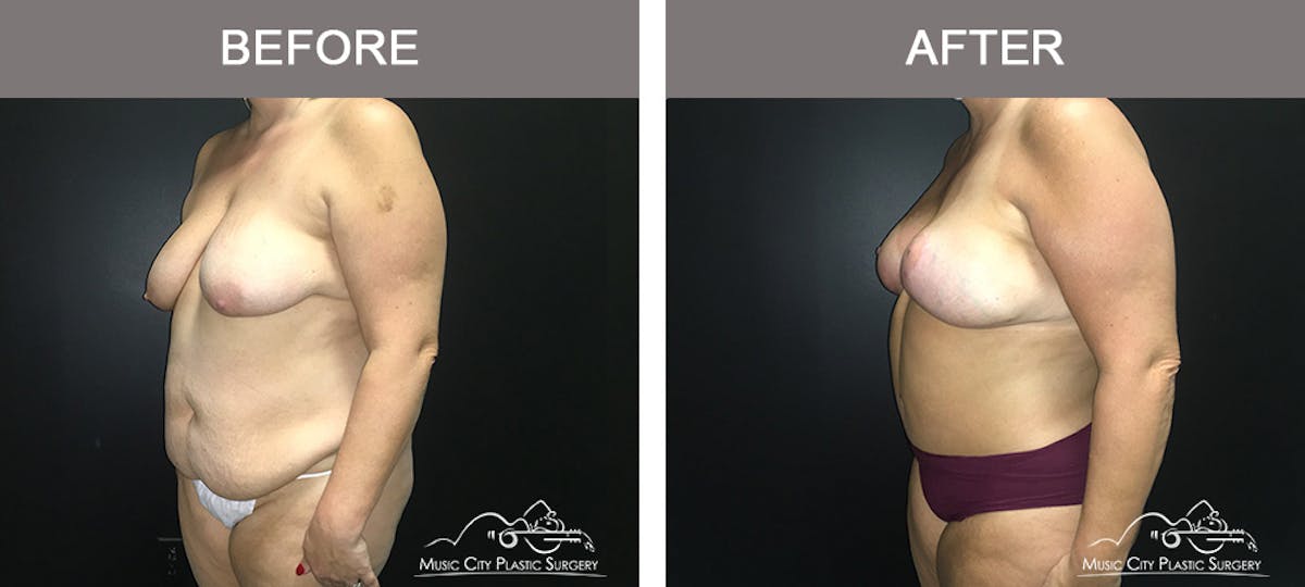 Breast Lift Before & After Gallery - Patient 339401 - Image 4