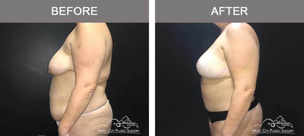 Breast Lift Before & After Gallery - Patient 339401 - Image 5