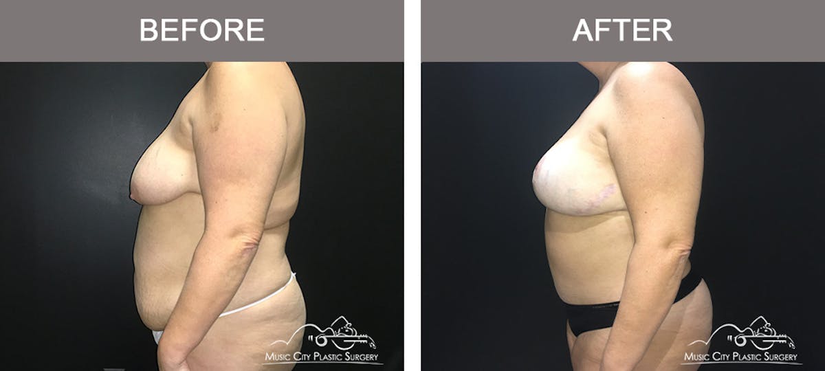 Breast Lift Before & After Gallery - Patient 339401 - Image 5