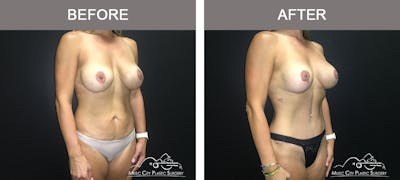 Breast Augmentation Before & After Gallery - Patient 226180 - Image 2