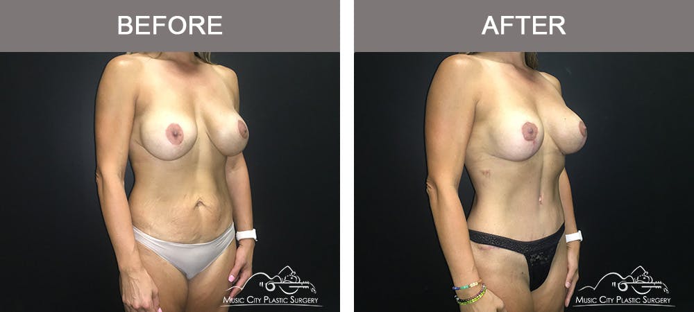 Breast Augmentation Before & After Gallery - Patient 226180 - Image 2