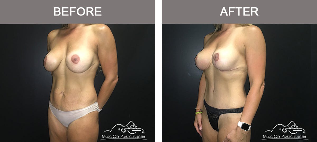 Breast Augmentation Before & After Gallery - Patient 226180 - Image 4