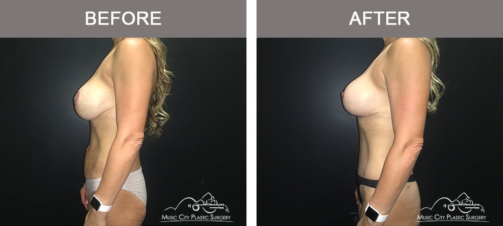 Breast Augmentation Before & After Gallery - Patient 226180 - Image 5